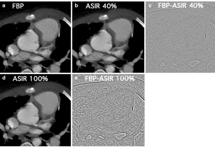 Figure 6 shows the effects of the two extreme conditions (FBP and 100% ASIR) on simple low- and high-contrast structures of the phantoms