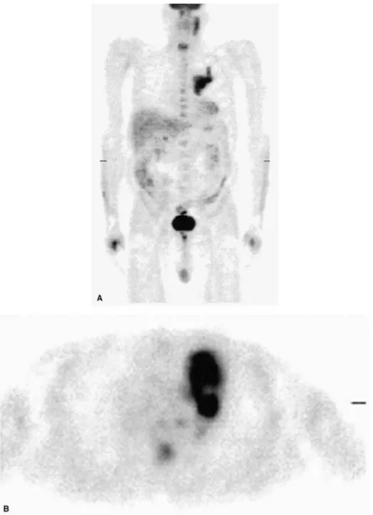 Figure 4. Positron emission tomography study, with fluoro-2-deoxy- D -glucose (F-18 FDG) used as the tracer, shown in the whole-body projection view (A) and transaxial view (B), demonstrates intense tumor uptake in the left upper lobe, near the left hilum,