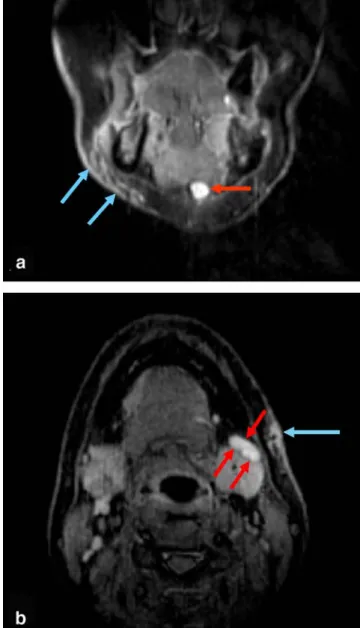 Fig. 1 Case 4, ligature strangulation. a Coronal STIR-weighted MR image (TR 3000, TE 14, TI 150) depicting a hyperintense  subcuta-neous region above the mandible on the left side (frame)