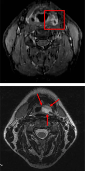 Fig. 3 Muscle findings in ligature strangulation (a, case 8) and a forearm choke hold (b, case 5)