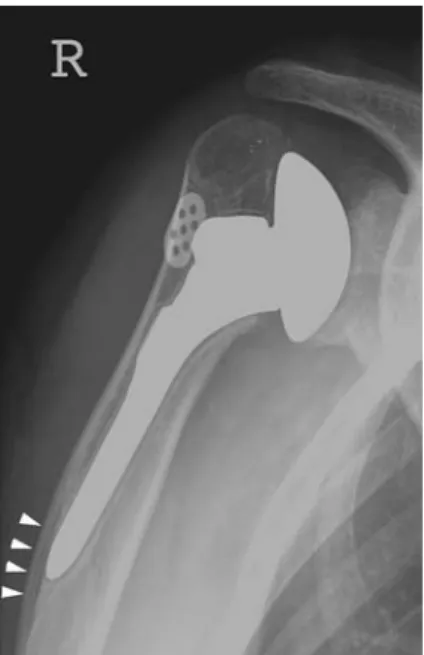 Fig. 9 Fracture and mild inferior dislocation of the acromion (white arrows) after semiconstrained inversed total prosthesis