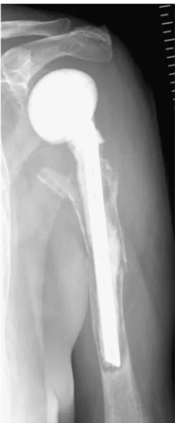 Fig. 10 Example of an antibi- antibi-otic-impregnated cement spacer after explantation of total shoulder arthroplasty due to  in-fection