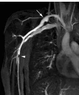 Fig. 1 Coronal MRA image shows aneurysm of the right subclavian artery (arrow) with peripheral filling defect due to a marginal thrombus and localised occlusion of the brachial artery (arrowhead)