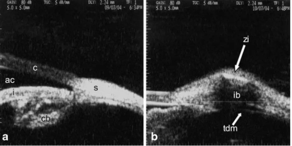 Fig. 3 Ultrasonic biomicro- biomicro-scopy preoperatively (a), and at 1 month post deep sclerectomy with (b) a zirconium implant.