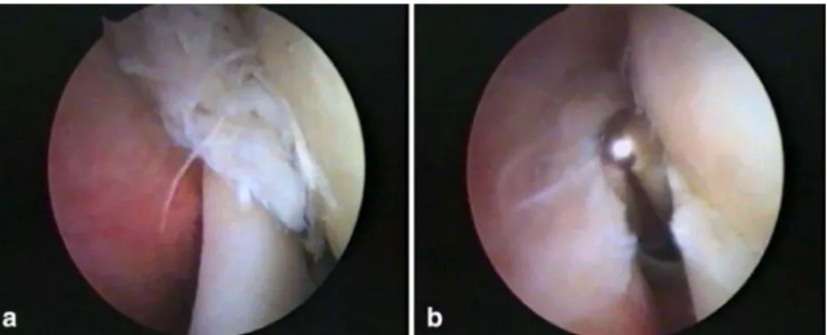 Fig. 1 a Arthroscopic view of a right shoulder showing  synovi-tis on the undersurface of rotator cuﬀ