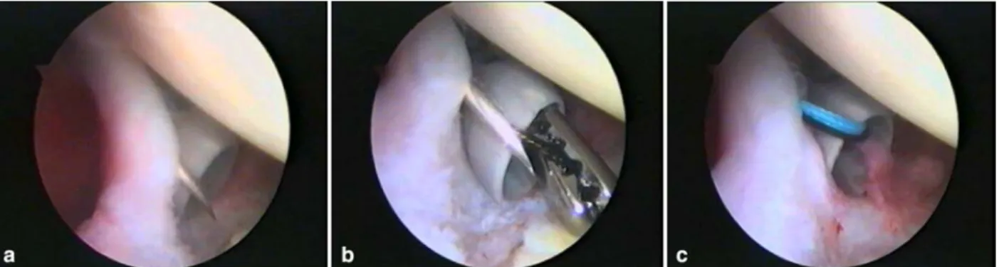 Fig. 2 a Arthroscopic view of the ﬁrst spinal needle transﬁxing the LHB tendon. b Shuttle relay derived through the spinal needle, pulled-out by a grasping clamp introduced through anterior portal.