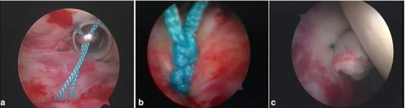 Fig. 4 a Arthroscopic view of subacromial space showing the sutures that are extracted through the anterior cannula using a grabber.