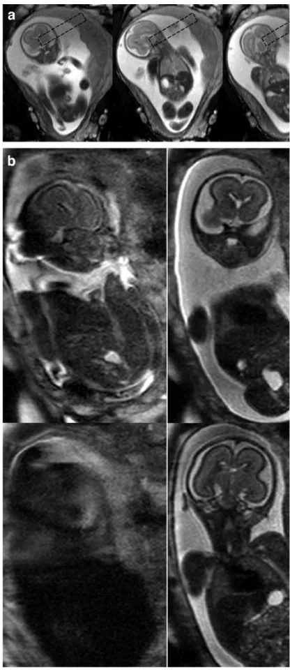Fig. 1 Images of a 37-year-old mother and her fetus at 21 5/7 gestational weeks. True FISP images (a) show a lateral movement of the head on coronal planes; the dashed line indicates positioning of the navigator