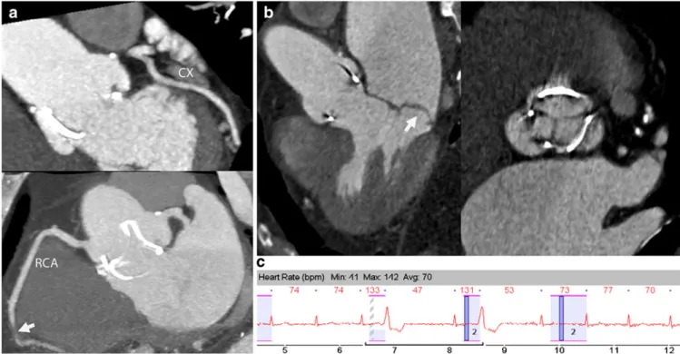 Fig. 2 pECG dual-step in a patient with arrhythmia (atrial ﬁ brillation and extrasystole)