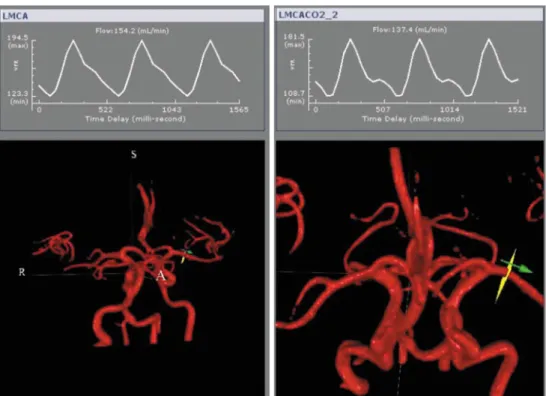Fig. 8  Snapshots of 3D images  displaying the site of the  loca-tion-cut for Left Middle Cerebral  Artery (LMCA, left) and the  same artery measured while  applying CO2 (LMCACO2_2,  right)