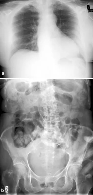 Fig. 2 A X-ray of thorax. B X-ray of abdomen postoperatively 101