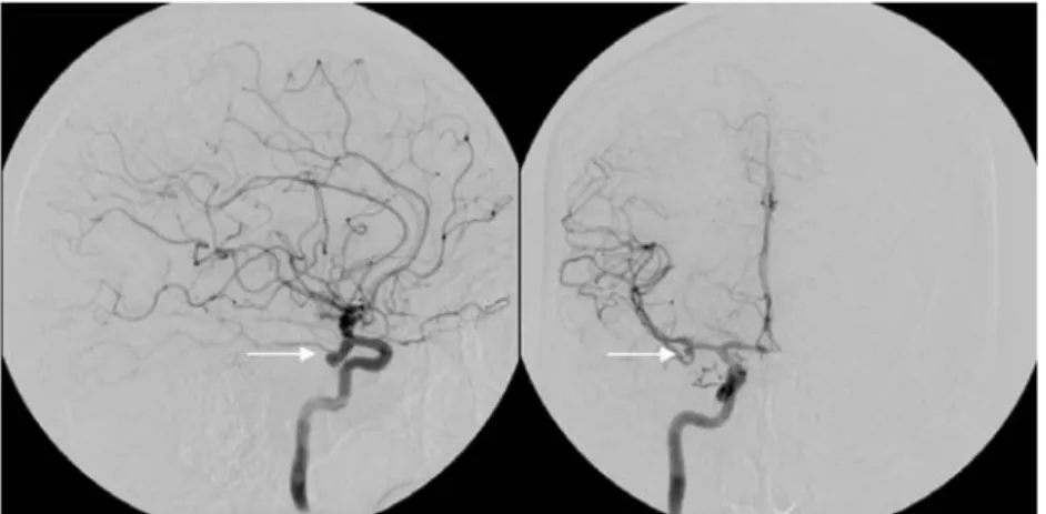 Fig. 4 Cerebral catheter angiography showing large aneurysm of the right posterior-communicating artery (left, arrow) and a smaller one of the right medial cerebral artery bifurcation (right, arrow)