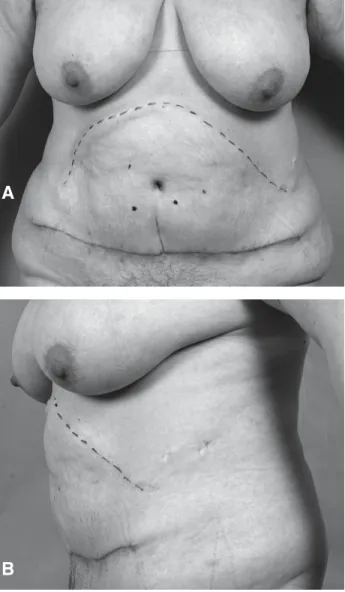 Figure 2. Preoperative views (the bilateral subcostal scar is indicated with a dotted line): A