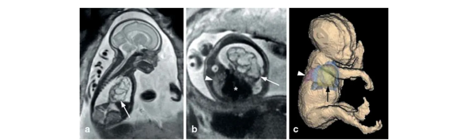 Fig. 3 Twenty-eight-week fetus with left lung CCAM. a Sagittal and  b axial T2-weighted SSFSE sequences (TR indefinite/TE 90 ms, slice thickness/gap 3–4/0 mm, FOV 32 cm, matrix 256×256), c 3D surface model
