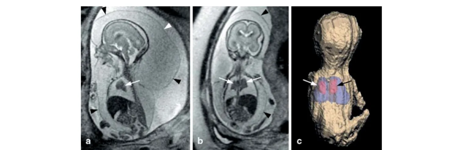 Fig. 6 Twenty-two-week fetus with hydrops fetalis. a Sagittal and b coronal T2-weighted SSFSE images (TR indefinite/TE 90 ms, slice thickness/gap 3–4/0 mm, FOV 32 cm, matrix 256×256) showing massive subcutaneous edema (arrowheads) and marked pleural effusi