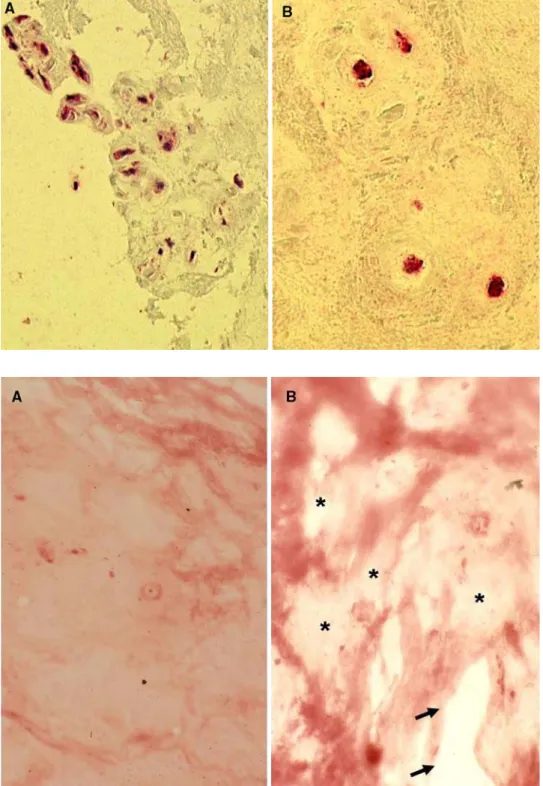 Fig. 8 In situ zymography of intervertebral disc samples. a Section through a disc sample with minimal gelatinolytic activity with mostly preserved gelatin matrix (red staining, Score 1, case #22)