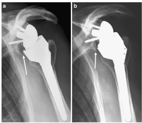 Fig. 2 Glenoid component loosening six months after reverse total shoulder arthroplasty (RTSA) for irreparable rotator cuff arthropathy and osteoarthritis