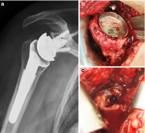 Fig. 3 Radiological anteropos- anteropos-terior view (a) and  intraopera-tive views (b, c) of an infected reverse total shoulder  arthro-plasty (RTSA)