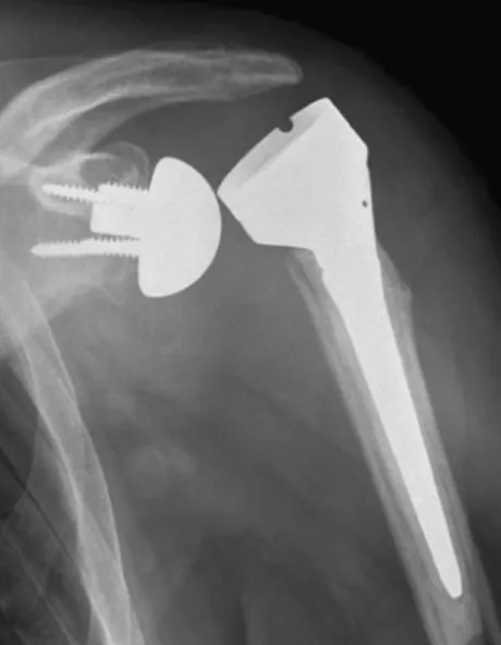 Fig. 5 Anteroposterior view of a reverse total shoulder arthroplasty (RTSA) with anterolateral dislocation