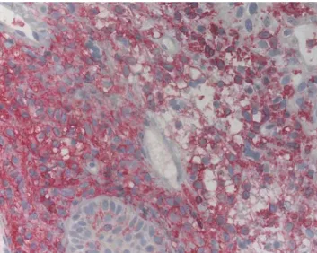 Fig. 3 Primarily membraneous staining of histiocytes with CD1a monoclonal antibody
