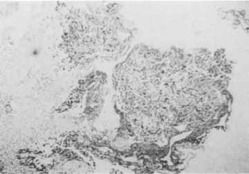 Fig.  1  Immunohistochemical  determination  of the  antibody  DO7  for overexpression  of p53  in a colon cancer  specimen,  serving  as a  positive  control 