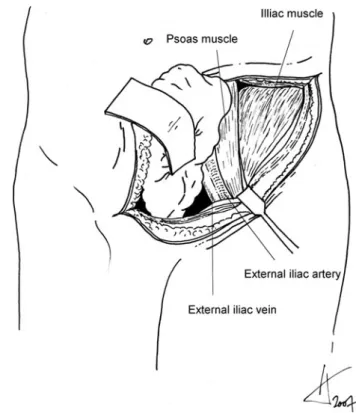 Fig. 1 Proximal extension of the incision parallel to the operating table (dotted line)