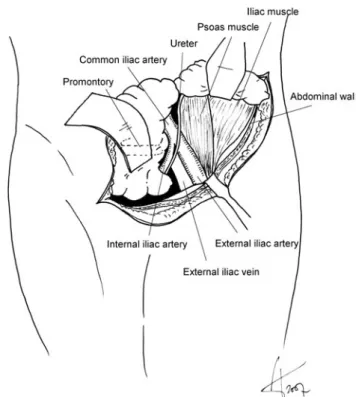 Fig. 4 Sympathetic nerves and the lymphatics overlying the external iliac artery are to be protected