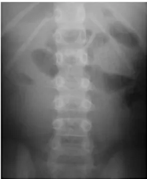 Fig. 3 Dynamic X-rays performed in flexion confirmed instability at two levels (L1-L2 and L2-L3) by the increased height of the  in-tervertebral foramina and by a widening of the posterior part of the intervertebral space