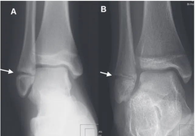 Fig. 4. A 13-year-old girl with supination trauma of the ankle. A: 