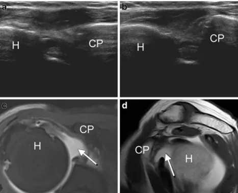 Fig. 2 Effusion in the subcapu- subcapu-lar recess (H= humeral head, CP= coracoid process)