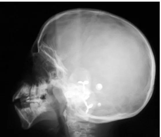 Fig. 11 External ear abnormalities. Axial CT shows atresia of right EAC with absent right ear pinna