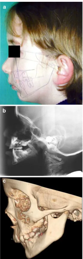 Fig. 18 Pierre Robin sequence in a 6-year-old girl. a Lateral picture with superimposed cephalometric analysis (Quick Ceph 2000)