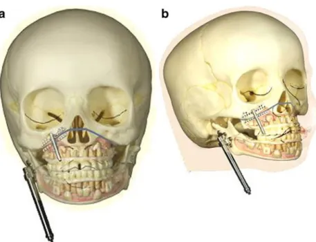 Fig. 4 a Clinical photograph shows transcutaneous abutments of two temporal fixtures. b Ear epithesis retained by endosseous implantsFig