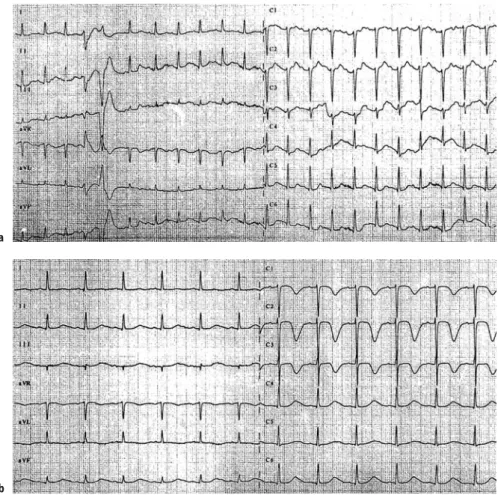 Fig. 2 Patient 2. a ECG on admission for acute pulmonary edema. b 8 h later, the ECG shows giant inverted T waves in leads V1–V3 and marked prolongation of the QT interval (QTc 626 ms)