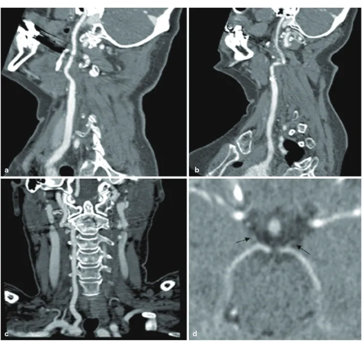 Fig. 1  Pre-interventional  computed  tomography  angiography  (CTA)  with  curved  reconstruction  showing  the  right  carotid  artery  (a),  the  left carotid artery (b), and the right vertebral artery (c), without any 