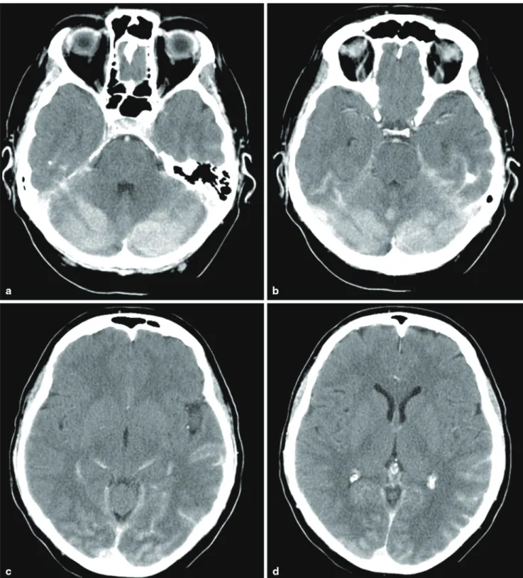 Fig. 3  Postinterventional CT performed 25 min after recanalization of  the  LSA  shows  extensive  areas  of  hyperdense  signal  symmetrically  distributed in both cerebellar hemispheres including white matter and 