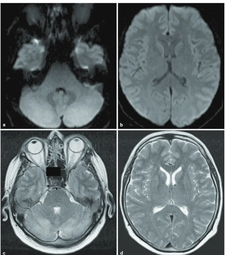 Fig. 4  The postinterventional MRI 6.5 h after intervention in digital- digital-weighted imaging (dWI) shows no signs of infarction or  hemorrha-ge (a, b)