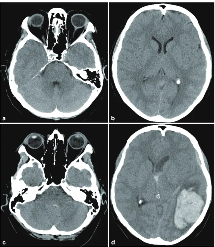Fig. 5  The unenhanced CT performed 23 h after intervention shows  some edema in the occipital lobes, the hyperdense signal in the  infra-tentorial and suprainfra-tentorial spaces however has completely diminished  (a, b), the CT after acute neurological d