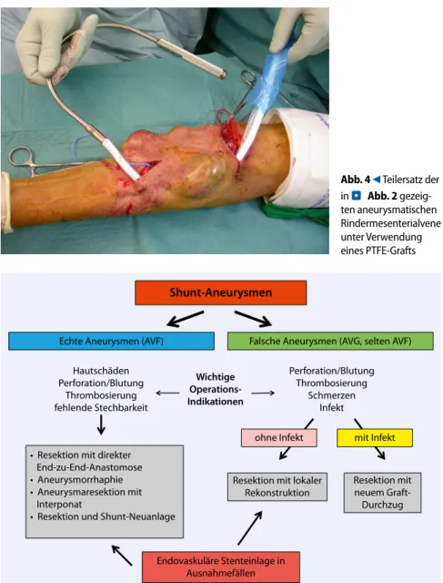 Abb. 5  8  Algorithmus zur Versorgung von Shuntaneurysmen Abb. 4  9  Teilersatz der in . Abb. 2 gezeig-ten aneurysmatischen  Rindermesenterial vene unter Verwendung eines PTFE-Grafts 118 |  Gefässchirurgie 2 · 2012Leitthema