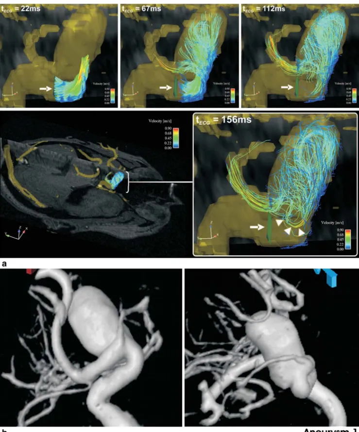 Fig. 1 Aneurysm 1, a parophthalmic ICA aneurysm. a Time-resolved 3-D particle traces in four consecutive systolic time-frames illustrate the flow dynamics