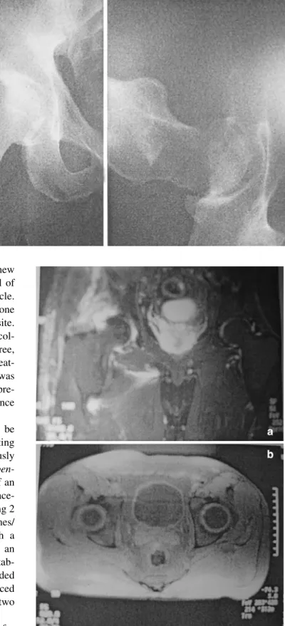 Fig. 2 a MRI showing a small collection at the upper border of the right acetabulum. b MRI showing that the infiltration interests also the right gluteus minimus muscle