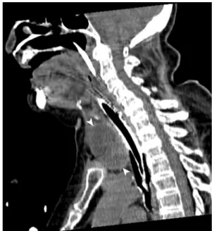 Fig. 2 Transversal cervical computed tomography. a Thyroidal homogenous hypodense mass including smaller hyperdensities (white arrows) with tracheal and vascular compression (black arrows)