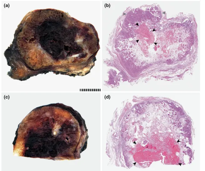Fig. 3 Thyroidectomy specimen. a, c Macroscopic images of cut surfaces of the thyroidectomy specimen with a large central hemorrhage