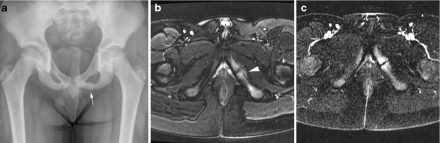 Fig. 3 A 16-year-old boy with posterior ankle pain. a Lateral radiograph of the ankle shows an os trigonum (arrow)