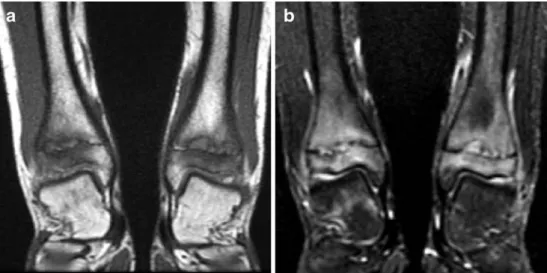 Fig. 7 A 12-year-old boy with elbow pain after skiing. Frontal (a) and lateral (b) radiographs show a lytic lesion in the radial metaphysis with cortical  disrup-tion and periosteal reacdisrup-tion