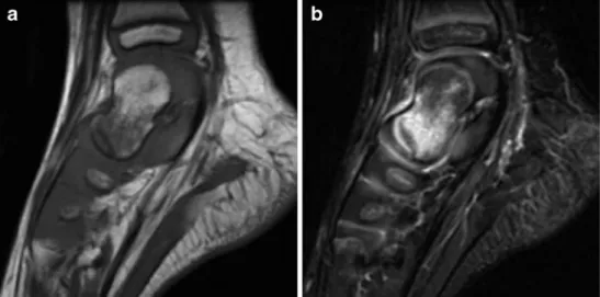 Fig. 10 MRI images of a 2- 2-year-old girl with  radiographi-cally occult fracture of the talus.