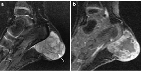 Fig. 11 MRI images of a 2- 2-year-old girl with a bluish mass at the left heel present since birth