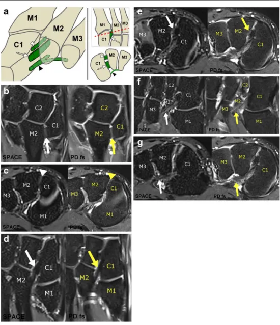 Diagram of the dorsal (white arrowhead), interosseous (white arrow), and plantar (black arrowhead) Lisfranc ligament connecting the first cuneiform with the basis of the second metatarsal, illustrated on a three-dimensional view (left), on a transverse vie