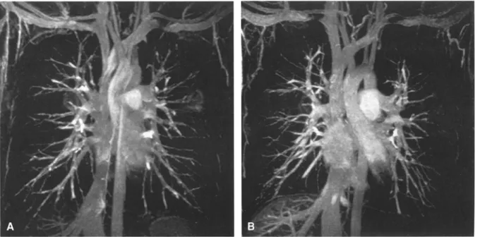 Fig.  1.  Maximum  intensity projection  (MIP) reconstructions  of 3D magnetic  resonance angiography  (MRA) data  sets col-  lected  after  the  intravenous  administration  of  NC100150  in  normal  volunteers