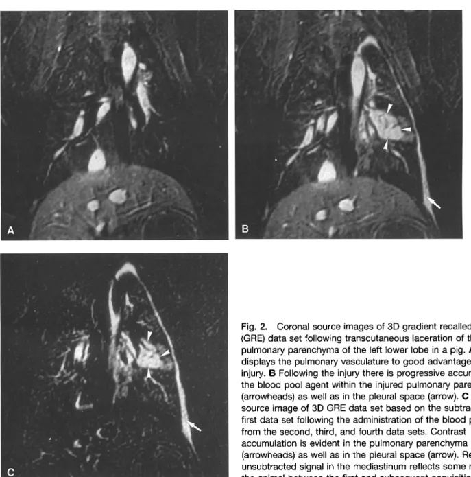 Fig.  2.  Coronal  source  images  of 3D  gradient  recalled  echo  (GRE) data  set following  transcutaneous  laceration  of the  pulmonary  parenchyma  of the  left  lower  lobe  in a pig
